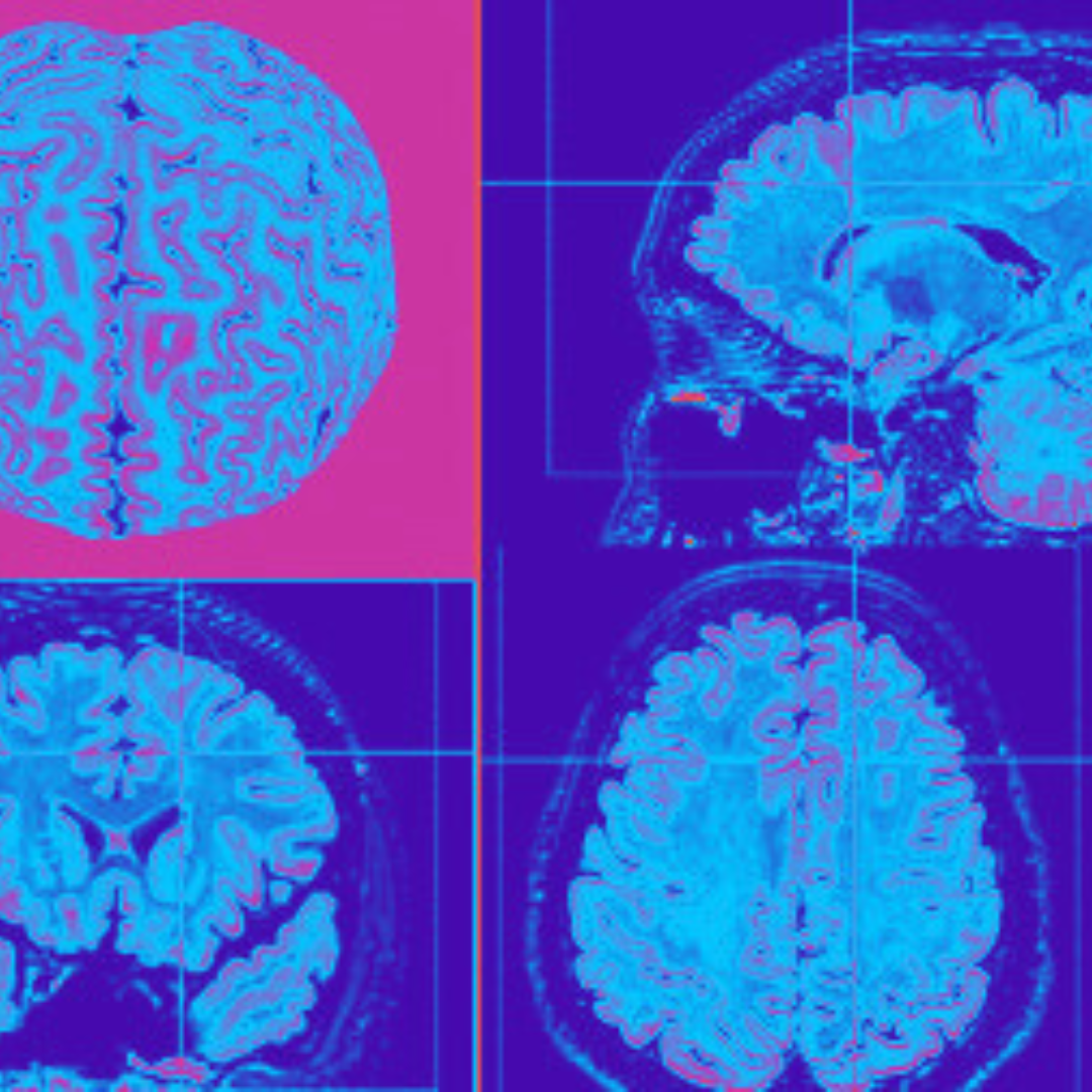 (Agência Fapesp) Ferramenta de IA detecta anormalidades cerebrais invisíveis em pessoas com epilepsia grave